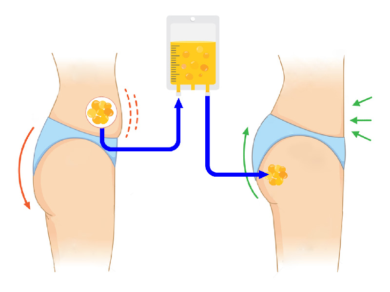 Buttocks surgery: buttock lift, body lift, buttock implants and