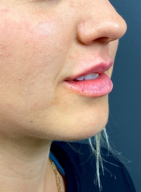 Lip Filler in Fargo North Dakota (2)