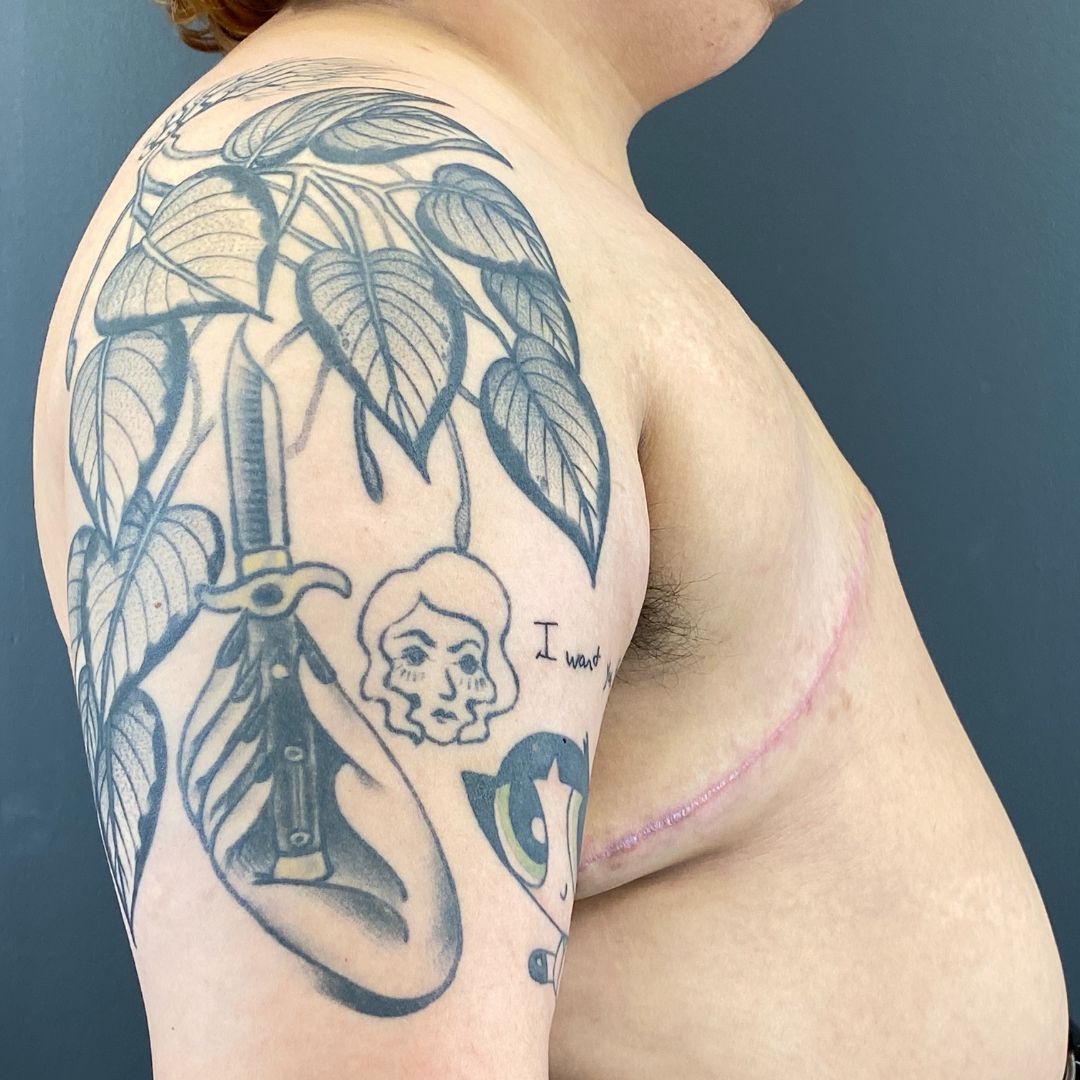 Top Surgery in Fargo North Dakota (5)