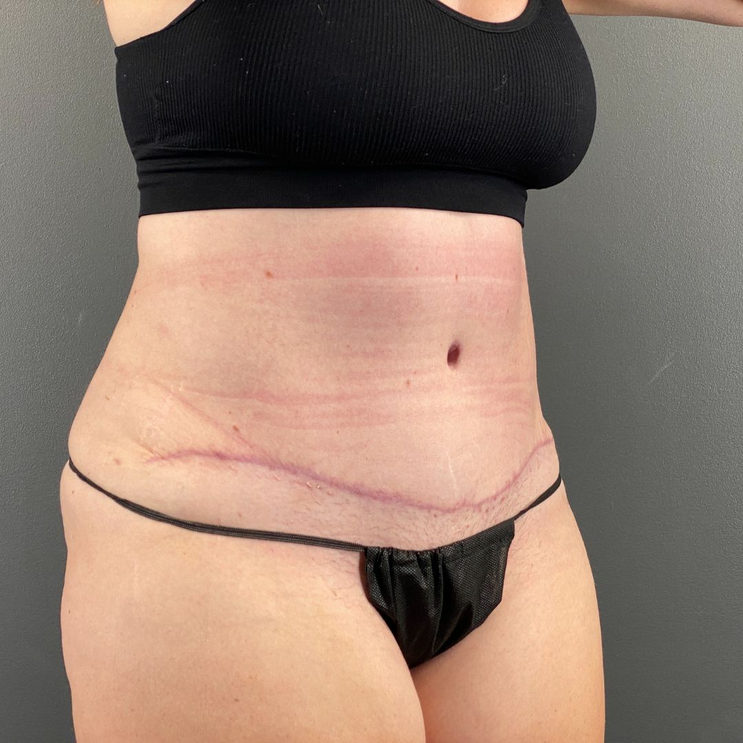 Tummy tuck in fargo north dakota (14)