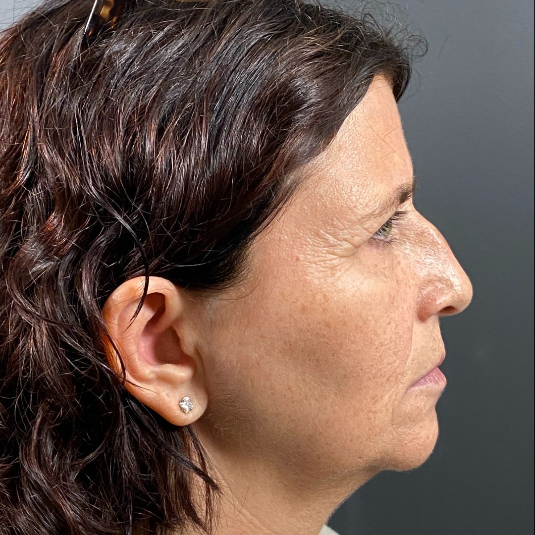 blepharoplasty in fargo north dakota (11)